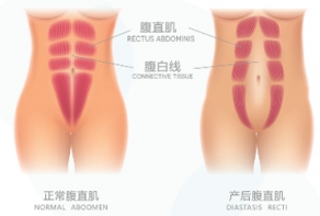 定安县产后腹直肌修复